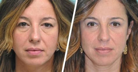 razoblachenie-mifov-o-blefaroplastike