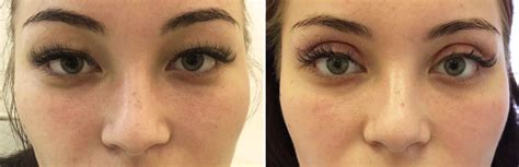 blefaroplastika-aziatskih-glaz-v-moskve