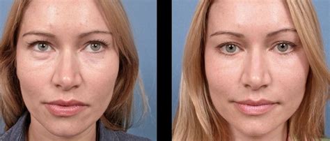 aziatskaya-blefaroplastika-foto-do-i-posle-operatsiya