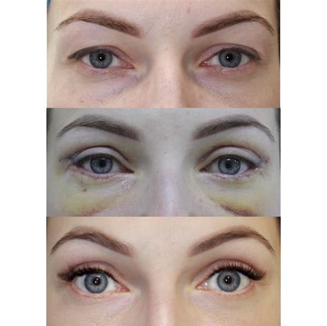 blefaroplastika-krugovaya-v-moskve-2