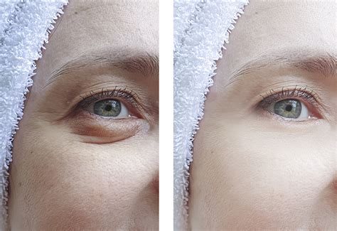 blefaroplastika-lazer-ili-skalpel-2