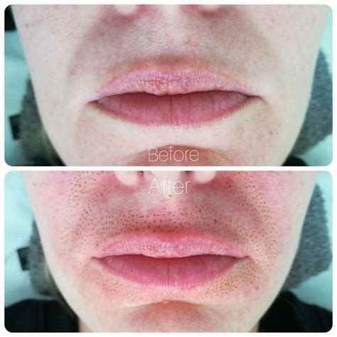 blefaroplastika-plasma-pen-osobennosti