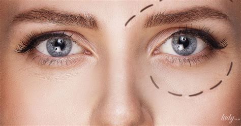 blefaroplastika-s-kantopeksiey-komu-nuzhna-otzyvy