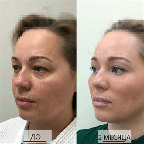 blefaroplastika-v-bryanske-2