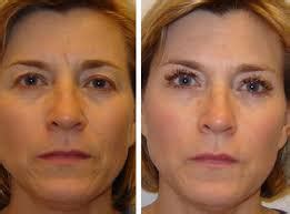 blefaroplastika-v-cherkesske-2