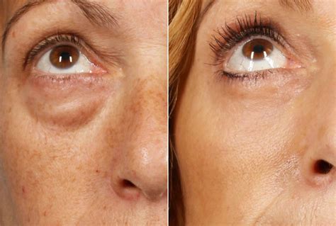 blefaroplastika-v-gomele-2