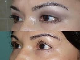 blefaroplastika-v-eliste
