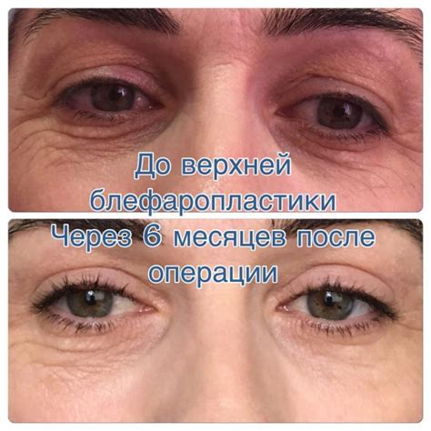 blefaroplastika-v-kaspiyske