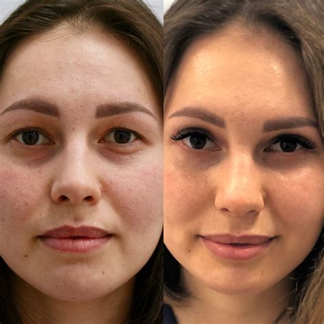 blefaroplastika-v-kirove-2