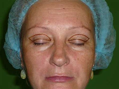 blefaroplastika-v-kolomne-2