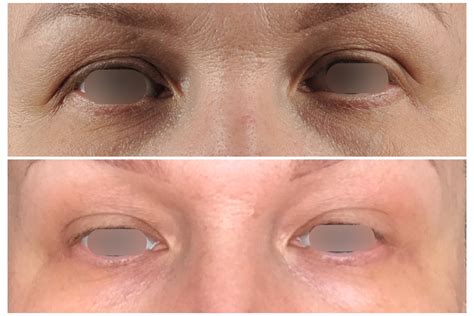 blefaroplastika-v-krasnodare-2