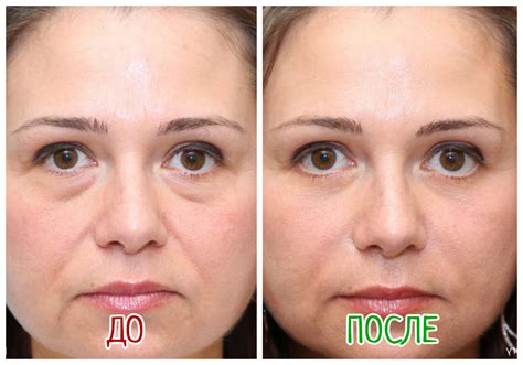 blefaroplastika-v-krasnoyarske-2