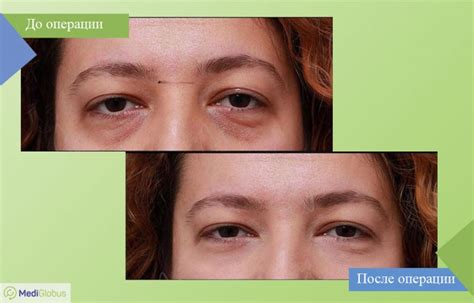 blefaroplastika-v-kurgane-2