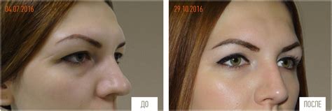 blefaroplastika-v-maykope