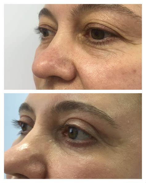 blefaroplastika-v-moskve-2