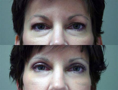 blefaroplastika-v-murome-2
