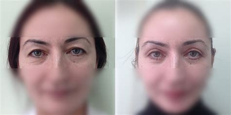 blefaroplastika-v-nazrani-2