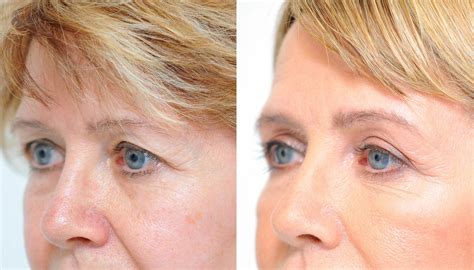 blefaroplastika-v-nevinnomysske-2