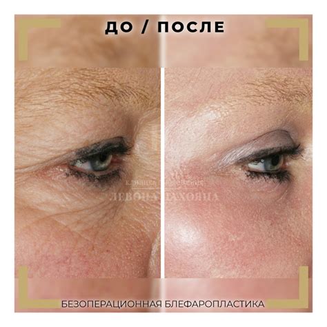 blefaroplastika-v-noginske-2