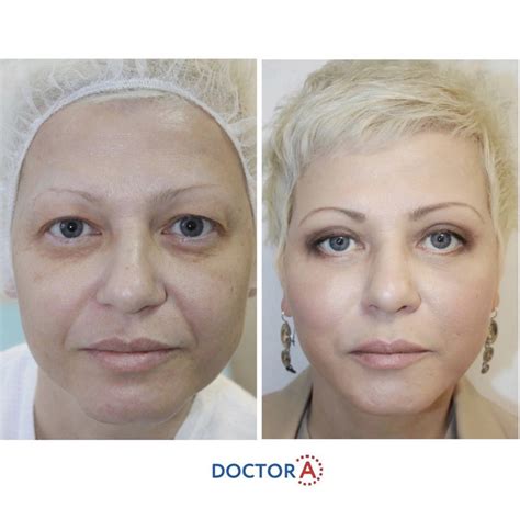 blefaroplastika-v-novocherkasske-2