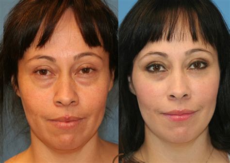 blefaroplastika-v-novom-urengoe-2