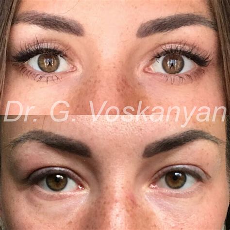 blefaroplastika-v-novorossiyske