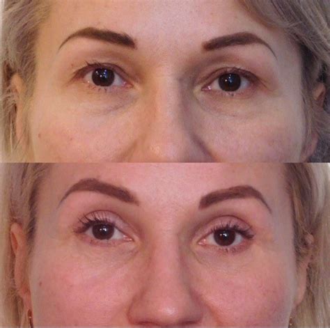 blefaroplastika-v-orehovo-zuevo-2