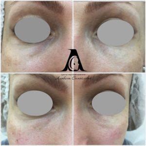blefaroplastika-v-orle-2