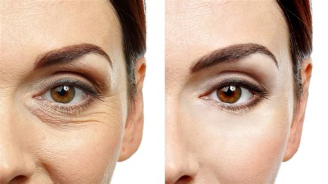 blefaroplastika-v-permi-2