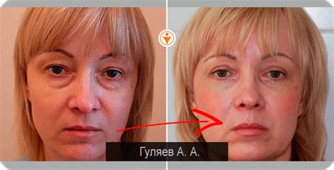 blefaroplastika-v-pyatigorske-2