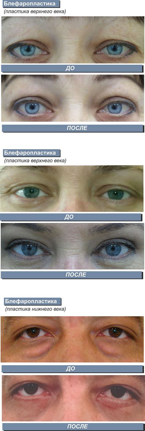 blefaroplastika-v-samare-2