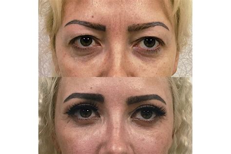 blefaroplastika-v-saratove-2