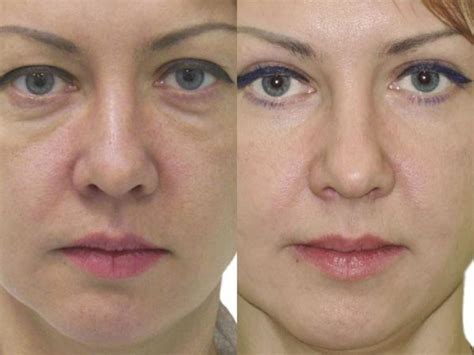 blefaroplastika-v-sochi-2