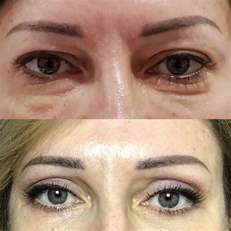 blefaroplastika-v-syktyvkare-2