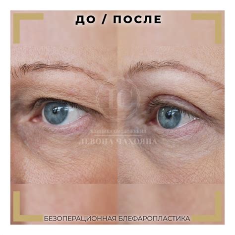 blefaroplastika-v-taganroge-2