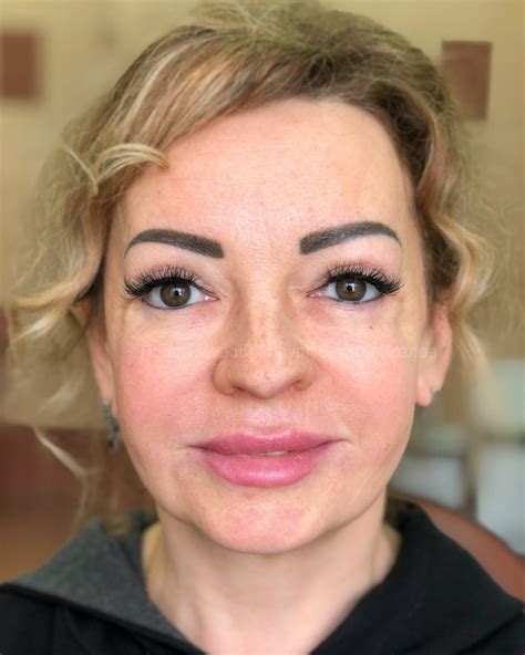 blefaroplastika-v-tolyatti-2