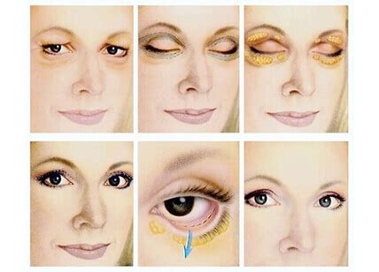 blefaroplastika-v-tveri-2