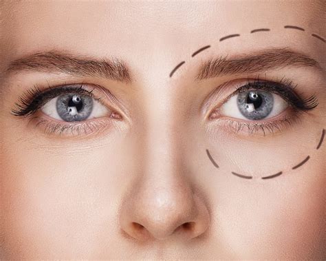 blefaroplastika-v-ufe-2