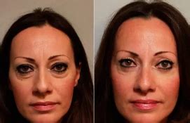 blefaroplastika-v-volzhskom-2