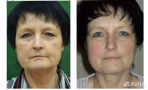blefaroplastika-v-yaroslavle-2