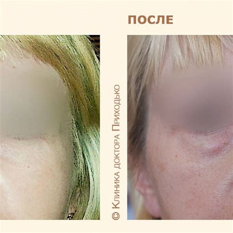 blefaroplastika-vo-vladivostoke-2