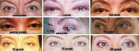 vosstanovlenie-po-dnyam-posle-blefaroplastiki-foto