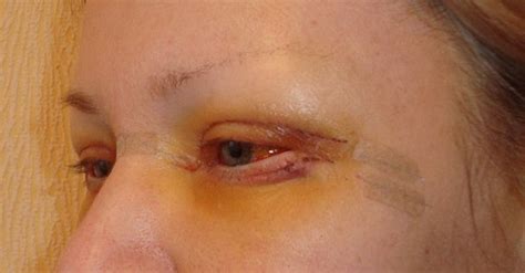 gryzha-nizhnego-veka-foto-operatsiya-udalenie