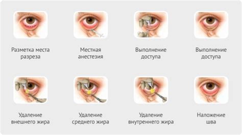 gryzha-verhnego-veka-foto-operatsiya-lechenie