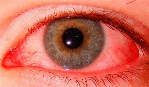 hemoz-posle-blefaroplastiki-kak-lechit