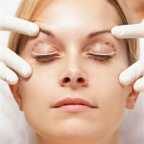 kak-podtyanut-verhnee-veko-v-domashnih-usloviyah-operatsiya-maski