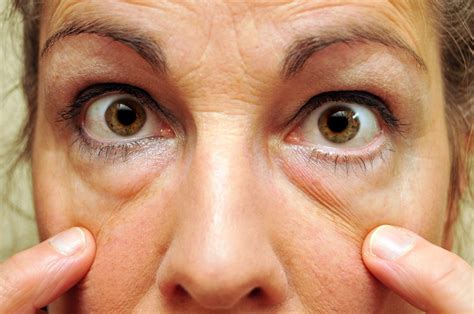 kak-ubrat-meshki-pod-glazami-hirurgicheskim-putem-tsena-foto-do-i-posle