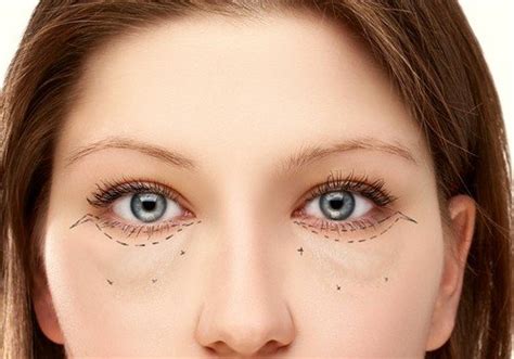 kak-ubrat-meshki-pod-glazami-v-domashnih-usloviyah-bystro-operatsiya