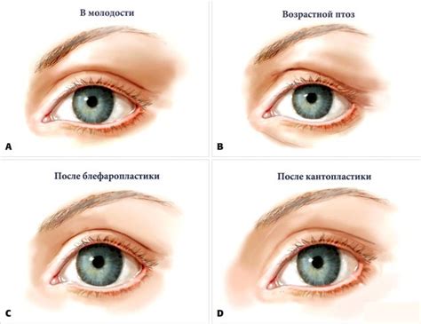 kantoplastika-glaz-chto-za-operatsiya-tsena-foto-do-i-posle