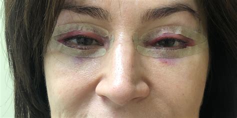 krugovaya-blefaroplastika-foto-tsena